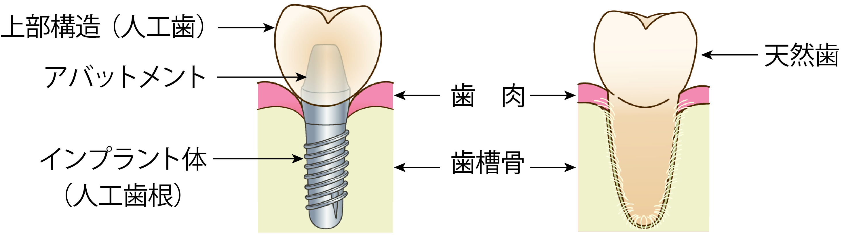 インプラント（人工歯根）の構造