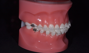 歯周病治療の流れ3-2